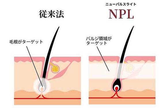 NPL脱毛